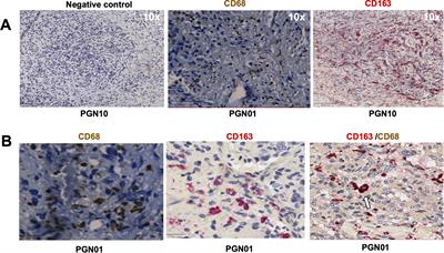 Functional analysis of fibroblasts and macrophages in head and neck paragangliomas